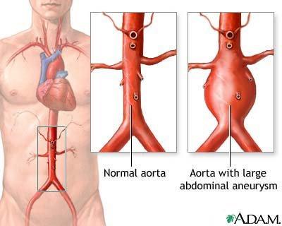 arteries of body diagram. extension of an artery or